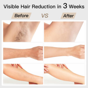 Bosidin Ipl Laser Hair Removal Device With Sr Skin Care Product Image Great Shop